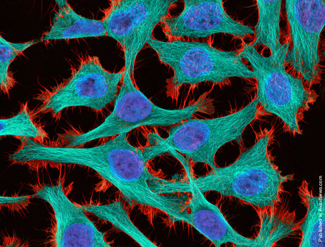 HeLa cancer cells viewed at 300x are seen in this 12th Place image by Thomas Deerinck from the National Center for Microscopy and Imaging Research in La Jolla, California. HeLa is an immortal cell line used in scientific research, made of cells originally sampled from cancer patient Henrietta Lacks in 1951